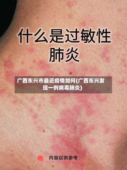 广西东兴市最近疫情如何(广西东兴发现一例病毒肺炎)-第3张图片